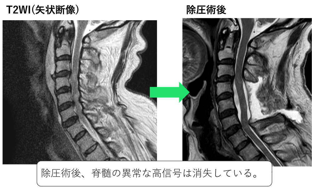 脊髄損傷のCT,MRI画像診断のポイント